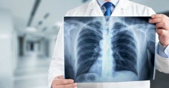 Rippenbruch: die Symptome erkennen | apomio Gesundheitsblog