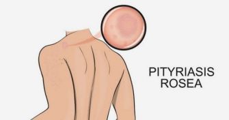 Röschenflechte: Ungefährliche Hautveränderung | apomio Gesundheitsblog