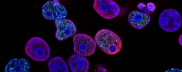 Leberkarzinom: Eine meist unbemerkte Krebsart | apomio Gesundheitsblog