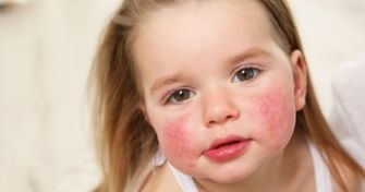 Ohrfeigenkrankheit - Ringelröteln bei Kindern | apomio Gesundheitsblog