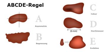 Dermatologie Spezial: Hautkrebs im Focus | apomio Gesundheitsblog