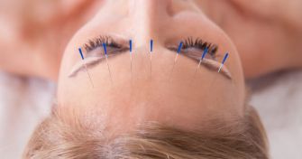 Heilender Piks: Gesund durch Akupunktur | apomio Gesundheitsblog