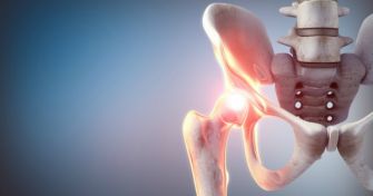 Hüftdysplasie: Hüftfehlstellung mit Folgen | apomio Gesundheitsblog