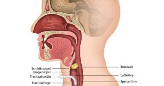 Luftröhrenschnitt: Therapie in Extremsituationen | apomio Gesundheitsblog