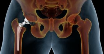 Prothesen: Der Alltagsretter nach Gelenkschäden | apomio Gesundheitsblog