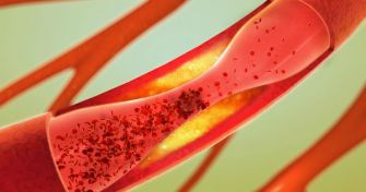 Thrombose: Blut verstopft Gefäße | apomio Gesundheitsblog